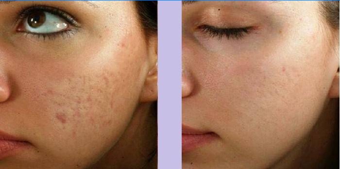 Fața femeii înainte și după masaj