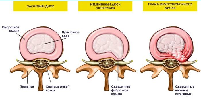 Protruzia și hernia discului intervertebral