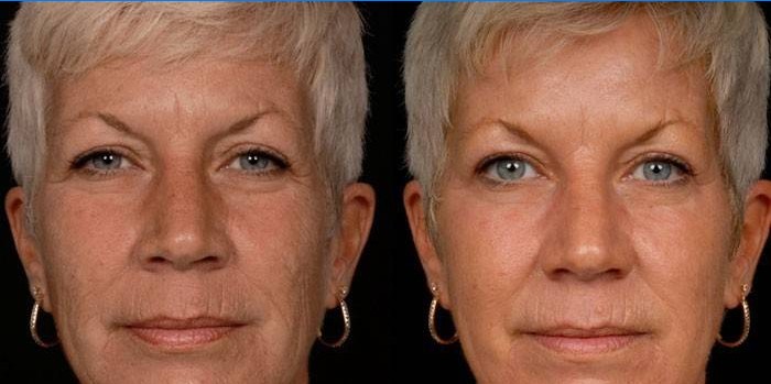 Fotografia unei femei înainte și după carboxiterapie