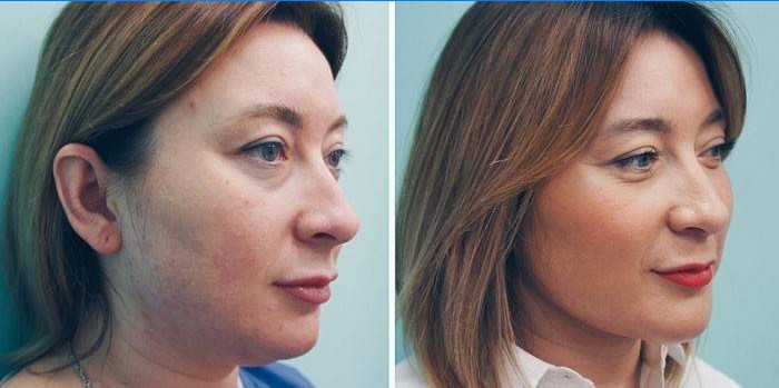 Femeie înainte și după injecții lipolitice