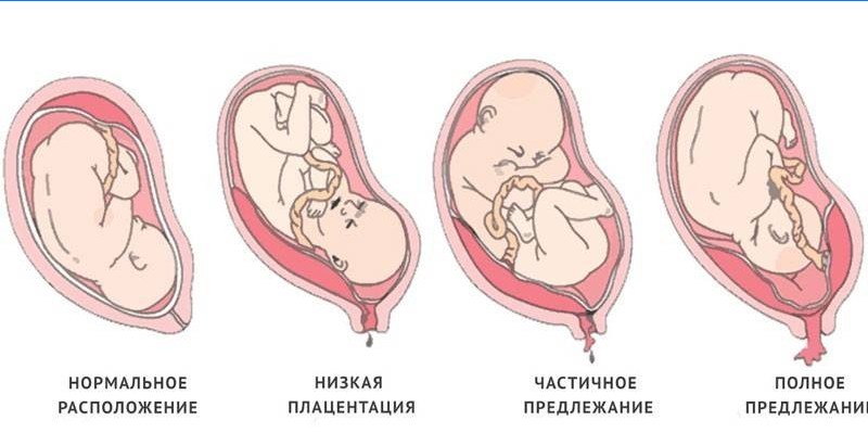 Tipuri de placenta previa