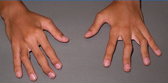 Artrita degetelor