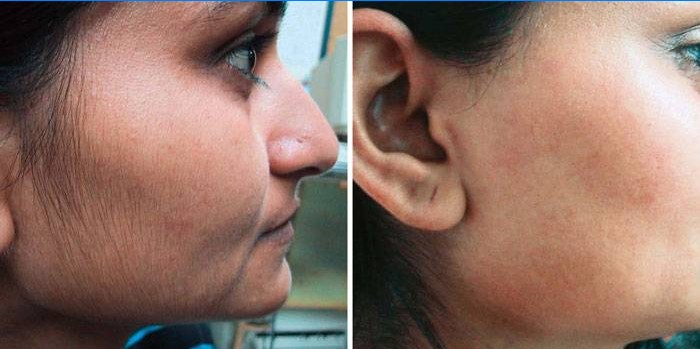 Epilarea cu laser pe față: înainte și după fotografii