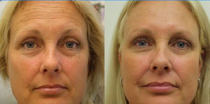 Fața femeii înainte și după ridicarea SMAS