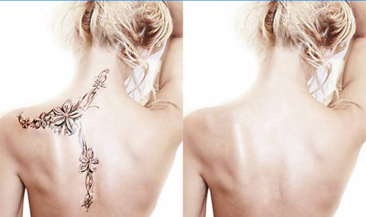 Fată înainte și după îndepărtarea tatuajului