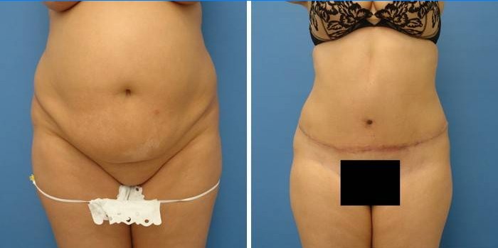 Fotografii înainte și după abdominoplastia abdomenului